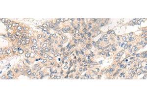 Immunohistochemistry of paraffin-embedded Human liver cancer tissue using CHRD Polyclonal Antibody at dilution of 1:40(x200) (Chordin 抗体)