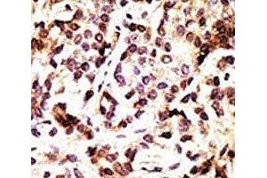 IHC analysis of FFPE human breast carcinoma tissue stained with the Beclin 1 antibody (Beclin 1 抗体  (AA 181-210))