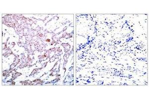 Immunohistochemical analysis of paraffin-embedded human breast carcinoma tissue using NFκB-p65 (Phospho-Ser536) Antibody (left) or the same antibody preincubated with blocking peptide (right). (NF-kB p65 抗体  (pSer536))