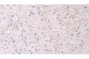 Detection of PANK4 in Human Glioma Tissue using Polyclonal Antibody to Pantothenate Kinase 4 (PANK4) (PANK4 抗体  (AA 639-773))