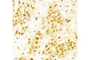 Immunohistochemistry of paraffin embedded human colon cancer using EFTUD2 (ABIN7073810) at dilution of 1: 2400 (400x lens) (EFTUD2 抗体)