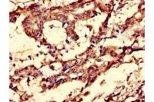 Immunohistochemistry of paraffin-embedded human gastric cancer using ABIN7148838 at dilution of 1:100 (Cyclin C 抗体  (AA 240-283))