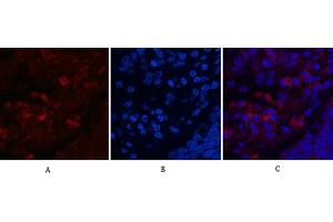 Immunofluorescence analysis of human lung cancer tissue.