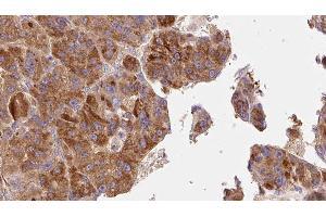 ABIN6277647 at 1/100 staining Human liver cancer tissue by IHC-P. (TACR1 抗体  (Internal Region))