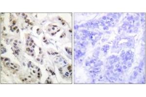 Immunohistochemistry analysis of paraffin-embedded human breast carcinoma tissue, using Lamin A/C (Ab-392) Antibody. (Lamin A/C 抗体  (AA 361-410))