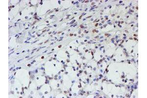 Immunohistochemical staining of paraffin-embedded Carcinoma of Human kidney tissue using anti-MLF1 mouse monoclonal antibody. (MLF1 抗体)