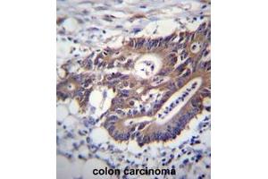 KRT12 Antibdy (C-term) immunohistochemistry analysis in formalin fixed and paraffin embedded human colon carcinoma followed by peroxidase conjugation of the secondary antibody and DAB staining. (KRT12 抗体  (C-Term))