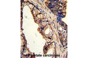 Formalin-fixed and paraffin-embedded human prostate carcinoma with TGM4 Antibody (Center), which was peroxidase-conjugated to the secondary antibody, followed by DAB staining. (TGM4 抗体  (Middle Region))