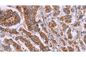 Immunohistochemistry of paraffin-embedded Human breast cancer tissue using DCTN6 Polyclonal Antibody at dilution 1:40 (DCTN6 抗体)