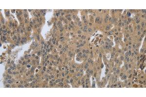 Immunohistochemistry of paraffin-embedded Human ovarian cancer tissue using PTPRT Polyclonal Antibody at dilution 1:30 (PTPRT 抗体)