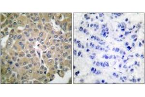 Immunohistochemistry analysis of paraffin-embedded human breast carcinoma tissue, using MART-1 Antibody. (MLANA 抗体  (AA 41-90))