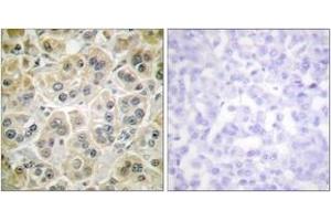 Immunohistochemistry analysis of paraffin-embedded human breast carcinoma tissue, using Vimentin Antibody. (Vimentin 抗体  (AA 411-460))