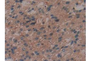 DAB staining on IHC-P; Samples: Human Glioma Tissue (IL29 抗体  (AA 20-200))