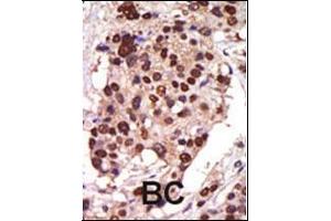 Formalin-fixed and paraffin-embedded human cancer tissue reacted with the primary antibody, which was peroxidase-conjugated to the secondary antibody, followed by AEC staining. (PRKD3 抗体  (AA 352-384))