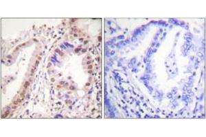 Immunohistochemistry analysis of paraffin-embedded human lung carcinoma tissue, using Estrogen Receptor-alpha (Ab-537) Antibody. (Estrogen Receptor alpha 抗体  (AA 501-550))