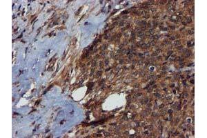 Immunohistochemical staining of paraffin-embedded Adenocarcinoma of Human breast tissue using anti-C1S mouse monoclonal antibody. (C1S 抗体)