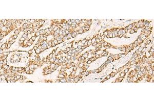 Immunohistochemistry of paraffin-embedded Human liver cancer tissue using COX6C Polyclonal Antibody at dilution of 1:25(x200) (COX6C 抗体)
