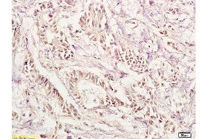 Formalin-fixed and paraffin embedded human gastric carcinoma labeled with Anti-PAX1 Polyclonal Antibody, Unconjugated (ABIN673269) at 1:200 followed by conjugation to the secondary antibody and DAB staining. (PAX1 抗体  (AA 151-250))