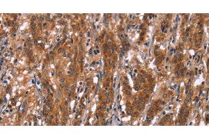 Immunohistochemistry of paraffin-embedded Human gastric cancer tissue using GPHN Polyclonal Antibody at dilution 1:30 (Gephyrin 抗体)