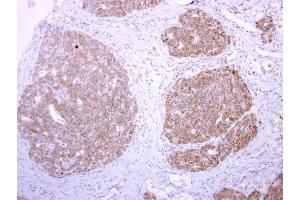 IHC-P Image tPA antibody detects tPA protein at cytoplasm on human colon carcinoma by immunohistochemical analysis. (PLAT 抗体)