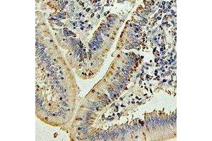 Immunohistochemical analysis of IL-27 staining in human colon cancer formalin fixed paraffin embedded tissue section. (IL-27 抗体)