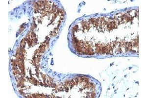 Formalin-fixed, paraffin-embedded human testicular carcinoma stained with Major Vault Protein antibody (1032).