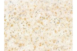 Ephrin B1/B2/B3 Antibody at 1/100 staining human astrocytoma by IHC-P. (Ephrin B1/B2/B3 (EFNB1/2/3) 抗体)