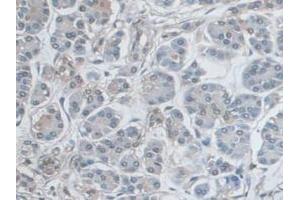 IHC-P analysis of Human Pancreas Cancer Tissue, with DAB staining. (ERK1 抗体  (AA 75-312))