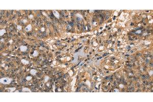 Immunohistochemistry of paraffin-embedded Human ovarian cancer tissue using HK3 Polyclonal Antibody at dilution 1:40 (HK3 抗体)