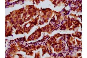 IHC image of ABIN7143405 diluted at 1:300 and staining in paraffin-embedded human lung cancer performed on a Leica BondTM system. (AEBP1 抗体  (AA 46-234))