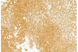 ABIN6265507 and ABIN6272873 at 1/100 staining Human esophageal cancer by IHC-P.