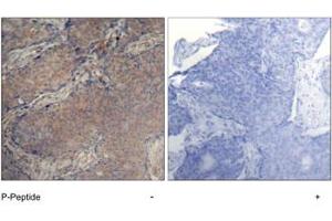 Imunohistochemical analysis of paraffin-embedded human breast carcinoma tissue, using MYL2 (phospho S19) polyclonal antibody . (MYL12A 抗体  (pSer18))