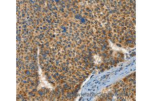 Immunohistochemistry of Human breast cancer using IFT74 Polyclonal Antibody at dilution of 1:60 (IFT74 抗体)