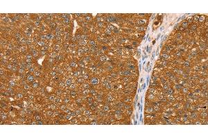 Immunohistochemistry of paraffin-embedded Human breast cancer tissue using ABCC8 Polyclonal Antibody at dilution 1:40 (ABCC8 抗体)