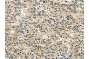 The image on the left is immunohistochemistry of paraffin-embedded Human liver cancer tissue using ABIN7193043(WDR91 Antibody) at dilution 1/20, on the right is treated with synthetic peptide. (WDR91 抗体)
