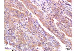 Formalin-fixed and paraffin embedded human breast cancer labeled with Rabbit Anti CA153/EMA/Mucin 1 Polyclonal Antibody, Unconjugated (ABIN673824) at 1:200 followed by conjugation to the secondary antibody and DAB staining (MUC1 抗体  (AA 1051-1255))