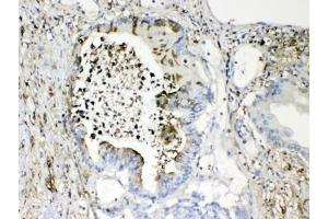 IHC testing of FFPE human intestinal cancer tissue with TMEM107 antibody at 1ug/ml. (TMEM107 抗体  (AA 22-57))