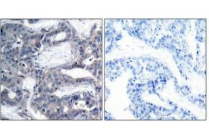 Immunohistochemical analysis of paraffin-embedded human breast carcinoma tissue using MEK-2(Phospho-Thr394) Antibody(left) or the same antibody preincubated with blocking peptide(right). (MEK2 抗体  (pThr394))