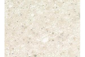 ABIN6264926 and ABIN6279887 at 1/100 staining human astrocytoma by IHC-P. (SART1 抗体  (C-Term))