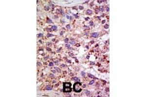Formalin-fixed and paraffin-embedded human cancer tissue reacted with the primary antibody, which was peroxidase-conjugated to the secondary antibody, followed by AEC staining. (USP11 抗体  (N-Term))