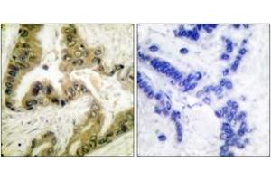 Immunohistochemistry analysis of paraffin-embedded human lung carcinoma tissue, using HDAC10 Antibody. (HDAC10 抗体  (AA 10-59))