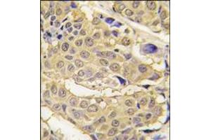 Formalin-fixed and paraffin-embedded human breast carcinoma tissue reacted with EPRS antibody (N-term), which was peroxidase-conjugated to the secondary antibody, followed by DAB staining. (EPRS 抗体  (N-Term))