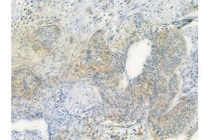ABIN6259034 and ABIN6275060 at 1/100 staining human cervical carcinoma by IHC-P. (DHODH 抗体  (Internal Region))