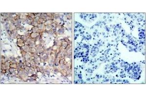 Immunohistochemistry analysis of paraffin-embedded human breast carcinoma, using HER2 (Phospho-Tyr877) Antibody. (ErbB2/Her2 抗体  (pTyr877))