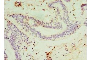 Immunohistochemistry of paraffin-embedded human breast cancer using ABIN7171169 at dilution of 1:100 (SYTL4 抗体  (AA 50-280))