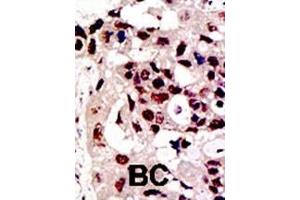 Formalin-fixed and paraffin-embedded human cancer tissue reacted with the primary antibody, which was peroxidase-conjugated to the secondary antibody, followed by DAB staining. (PIAS3 抗体  (AA 588-619))