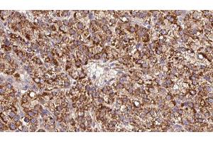 ABIN6279609 at 1/100 staining Human liver cancer tissue by IHC-P. (CHRNB3 抗体  (Internal Region))