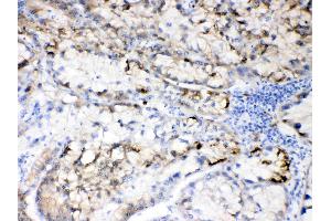 Hepatitis B Virus was detected in paraffin-embedded sections of human liver cancer tissues using rabbit anti- Hepatitis B Virus Antigen Affinity purified polyclonal antibody (Catalog # ) at 1 µg/mL. (HBV Large S Protein 抗体  (N-Term))