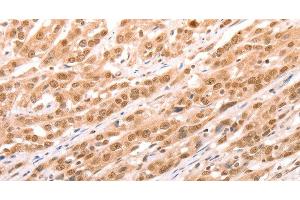 Immunohistochemistry of paraffin-embedded Human esophagus cancer tissue using TAX1BP1 Polyclonal Antibody at dilution 1:60 (TAX1BP1 抗体)