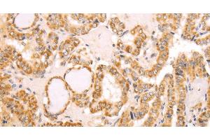 Immunohistochemistry of paraffin-embedded Human thyroid cancer using NAMPT Polyclonal Antibody at dilution of 1:30 (NAMPT 抗体)